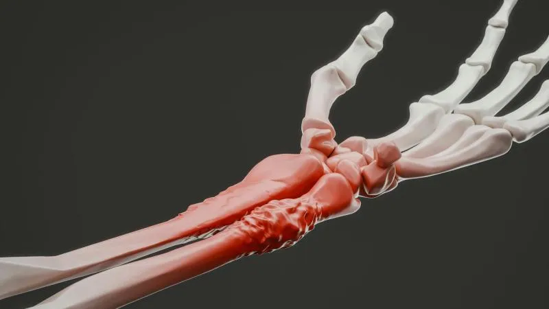 Ostéosarcome et ablation du cancer des os