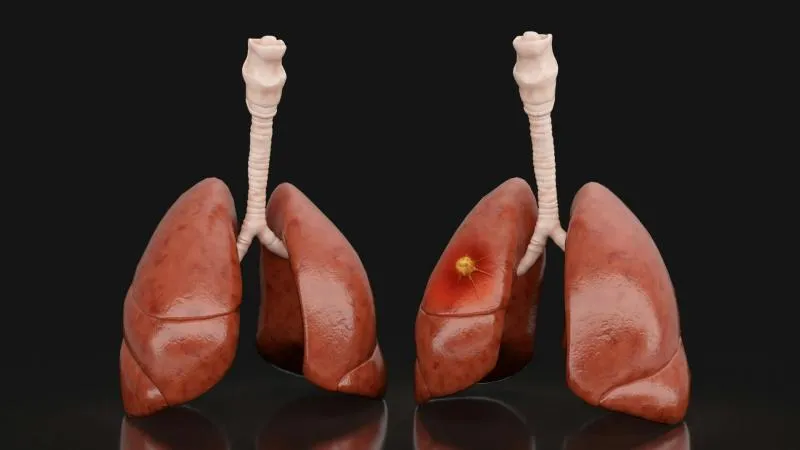 Chirurgie du cancer du poumon