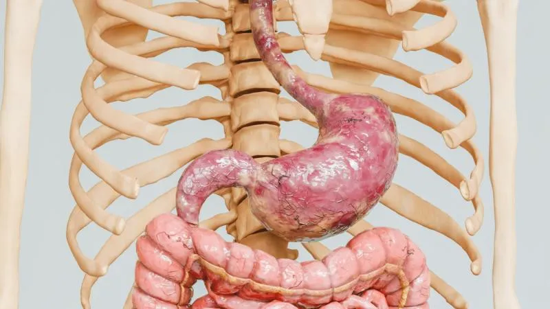 Chirurgie du cancer gastrique - chirurgie du cancer de l’estomac