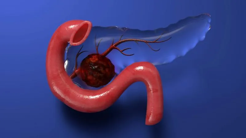 Chirurgie du cancer du pancréas