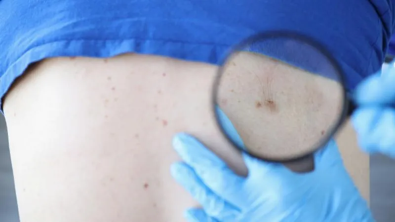 Chirurgie du cancer de la peau