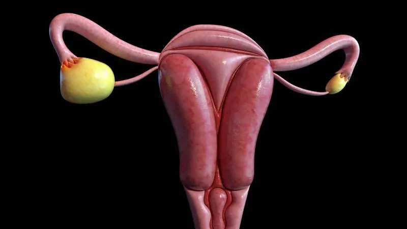 Chirurgie de cytoréduction - réduction tumorale du cancer de l’ovaire
