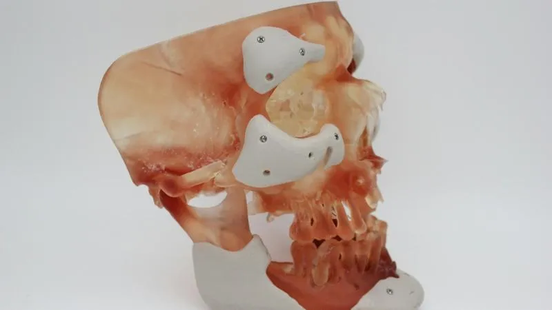 Résection de tumeur osseuse