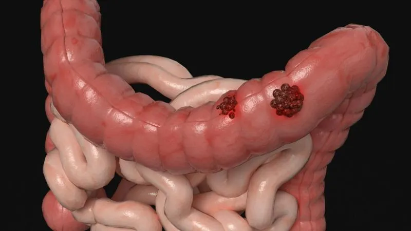 Chirurgie du cancer du côlon
