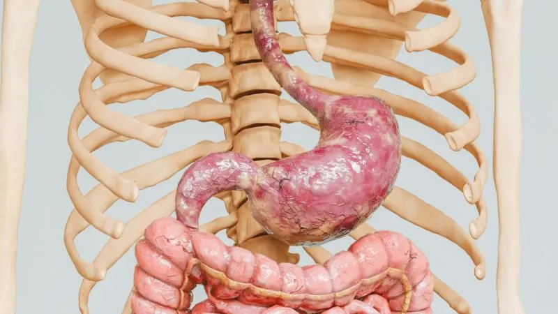 Chirurgie du cancer de l’estomac - Chirurgie du cancer gastrique