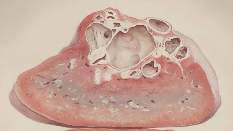 Résection d’une tumeur du pancréas