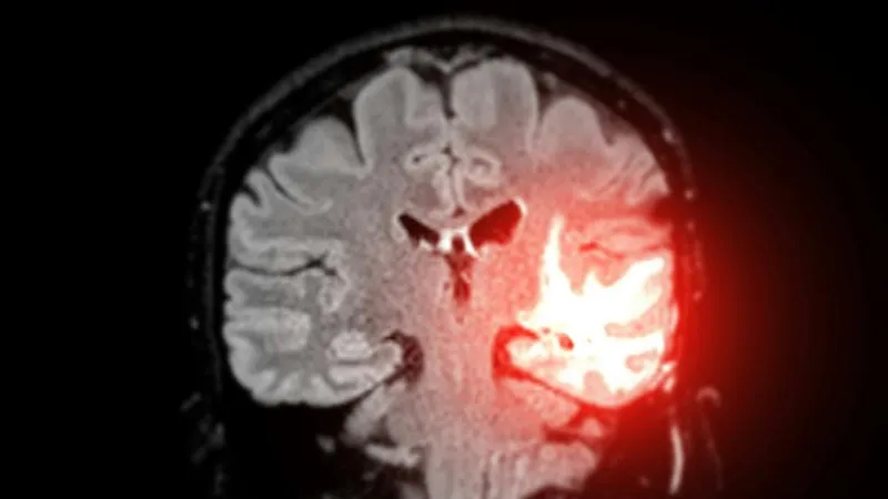 Chirurgie des tumeurs cérébrales - Ablation d’une tumeur cérébrale