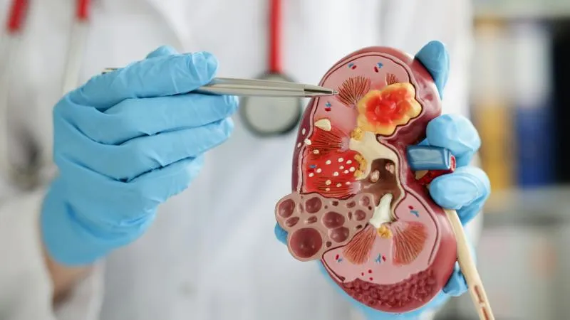 Chirurgie du cancer du rein - Chirurgie du cancer rénal