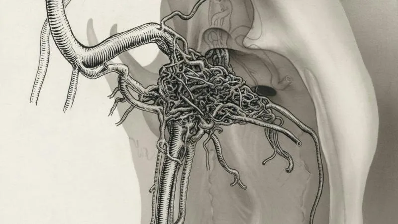 Orchidectomie radicale - chirurgie d’ablation du testicule