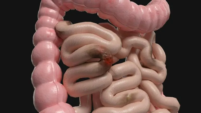 Résection muqueuse endoscopique - EMR