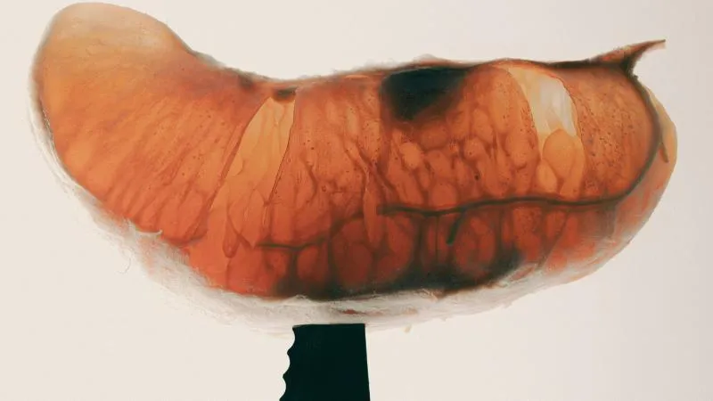 Dissection sous-muqueuse endoscopique - ESD