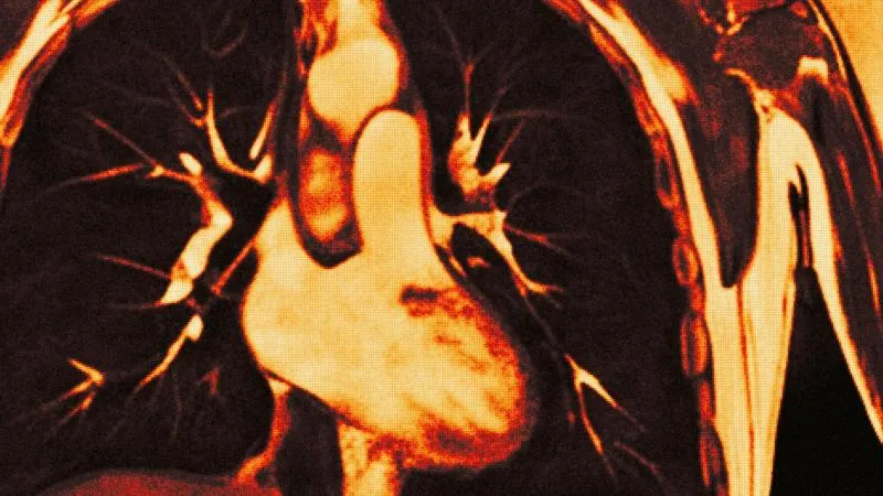 Lobectomie par VATS pour le cancer du poumon