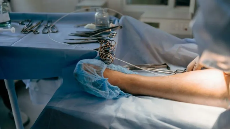 Traitement des varices