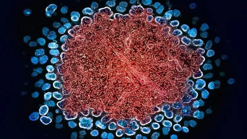 Thérapie par sacituzumab govitécan - Trodelvy