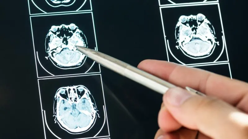 Scanner TEP/TDM au Dotatate - imagerie des tumeurs neuroendocrines