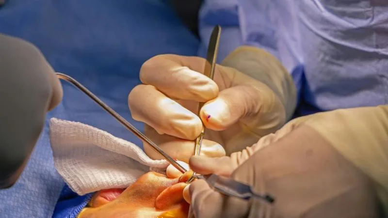 Septoplastie - chirurgie de la cloison nasale déviée