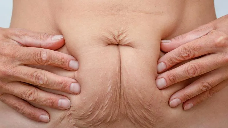 Liposuccion Vaser
