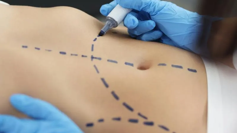 Liposuccion 360 du corps