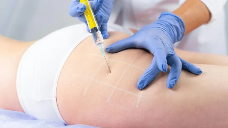 Lifting brésilien des fesses - chirurgie BBL