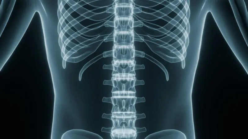 Chirurgie de la scoliose chez l’enfant