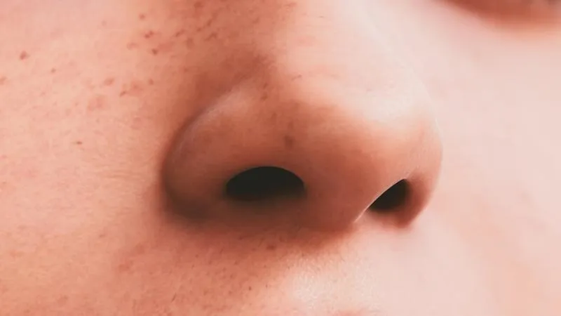Chirurgie des polypes nasaux