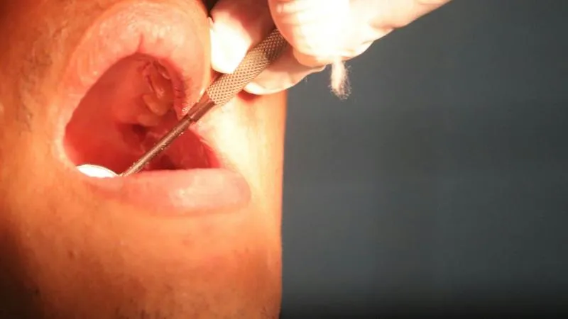 Amygdalectomie chirurgie d’ablation des amygdales