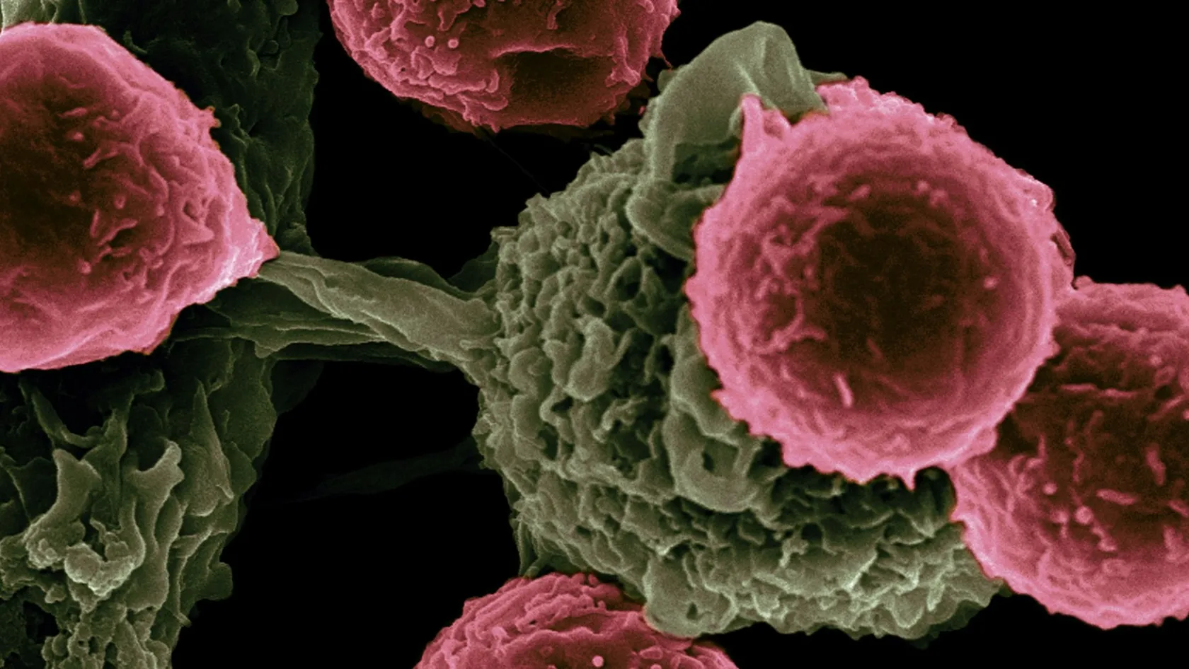 Pourquoi le lymphome survient-il ? Causes et facteurs favorisants