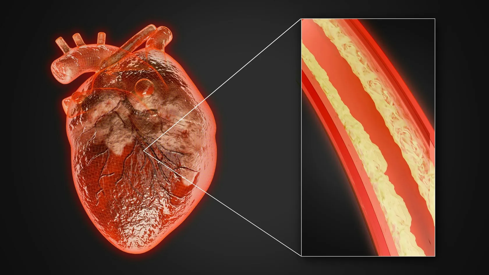 Chirurgie TAVI implantation valvulaire aortique par cathéter