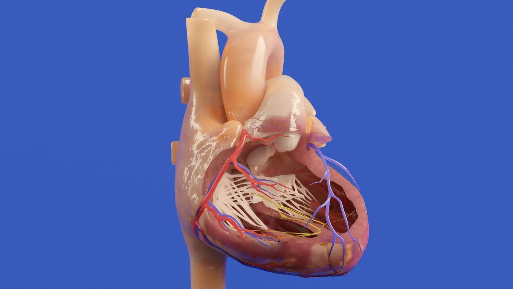 Remplacement valvulaire mitral par cathéter (TMVR)
