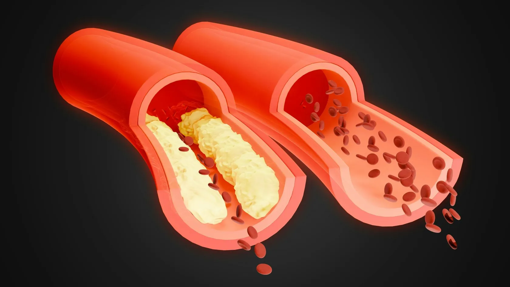 Angioplastie coronaire
