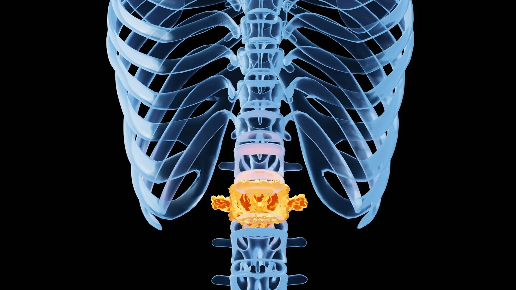Chirurgie du disque lombaire