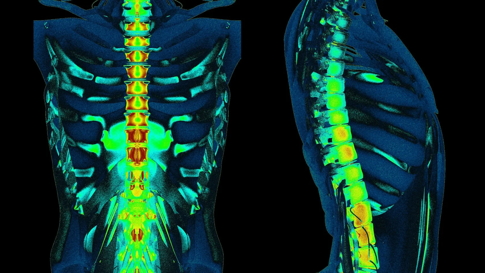 Microdiscectomie cervicale - chirurgie mini-invasive du disque cervical