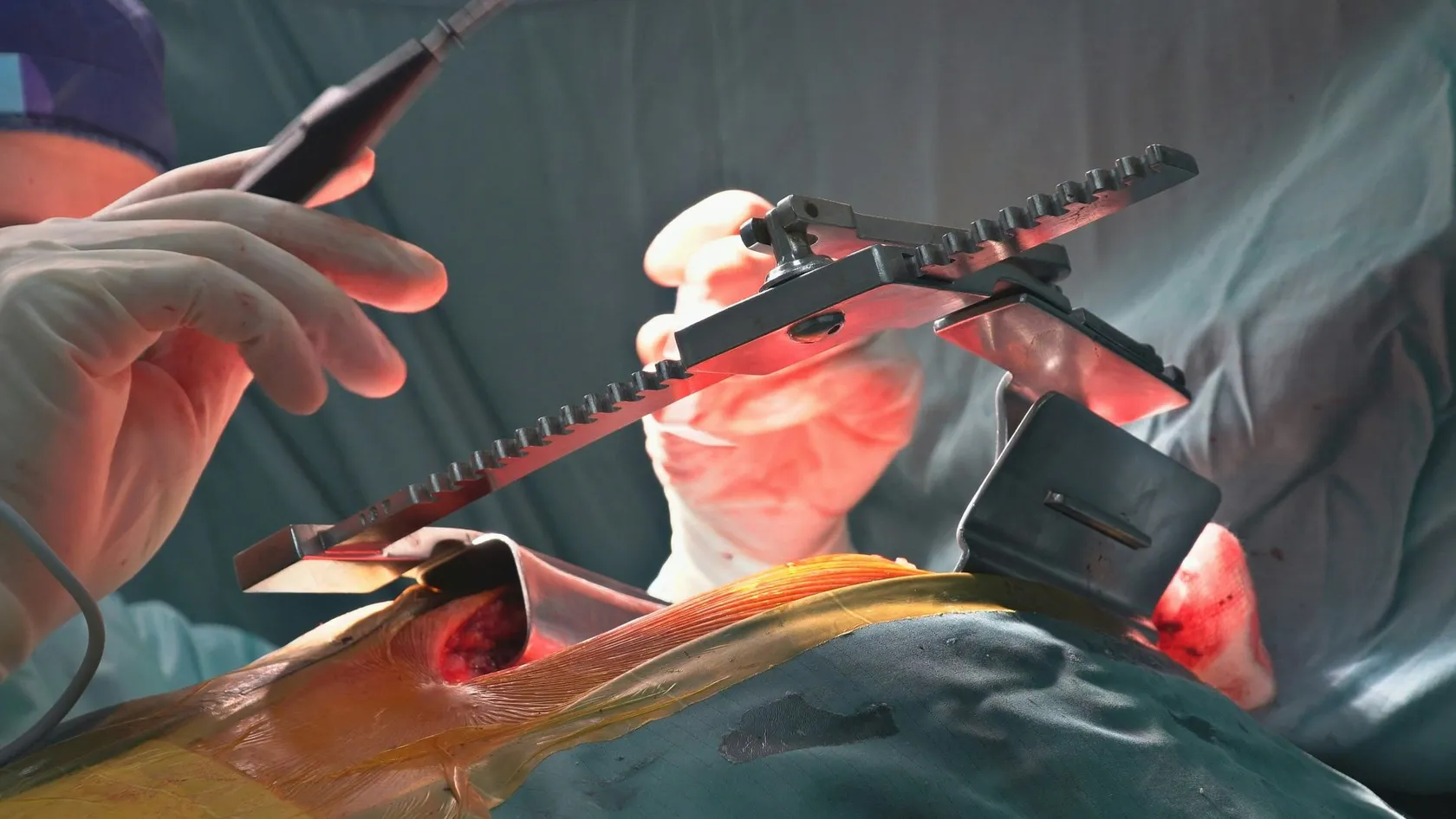 TLIF - Chirurgie de fusion intersomatique lombaire par voie transforaminale