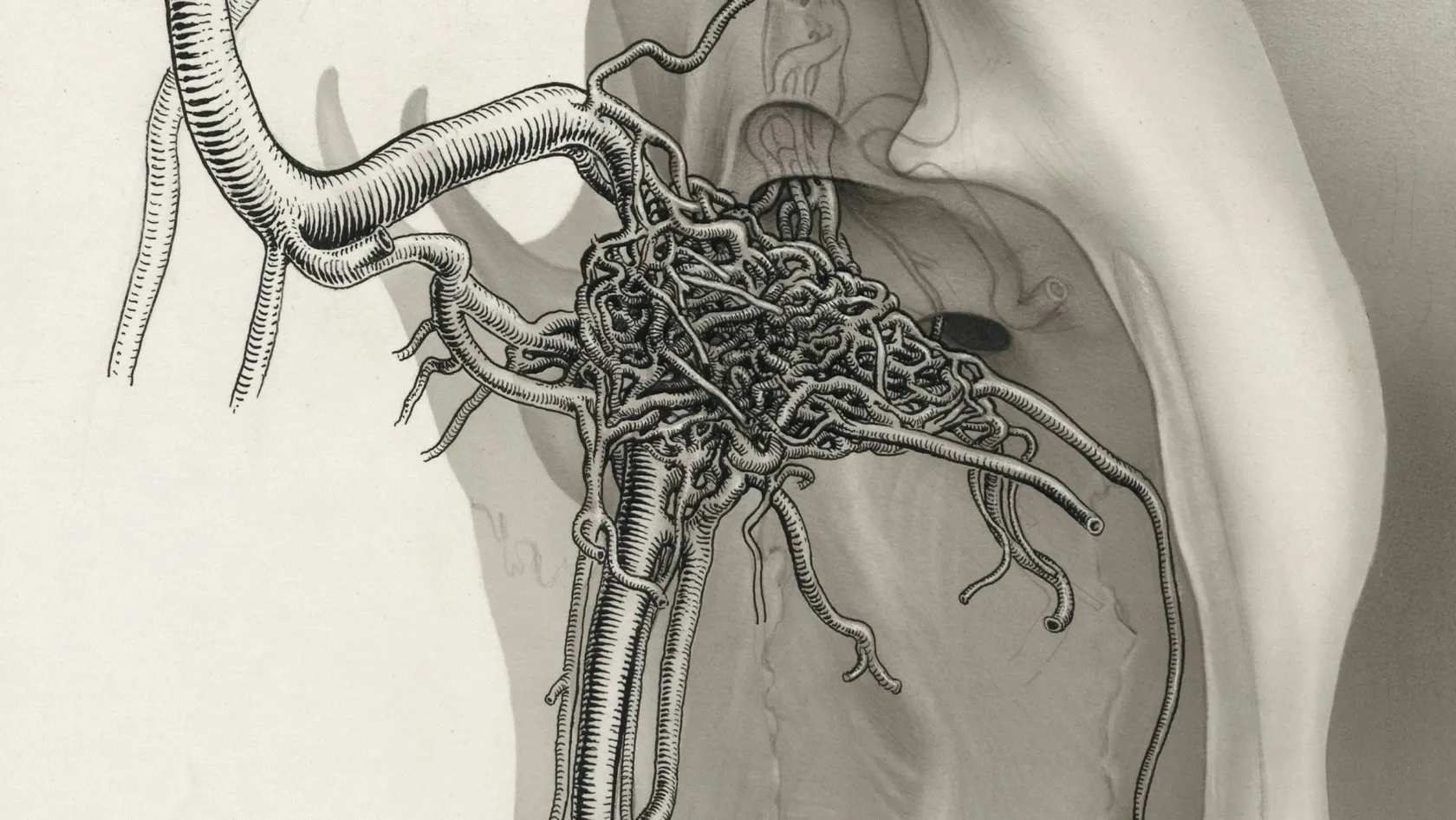 Orchidectomie radicale - chirurgie d’ablation du testicule