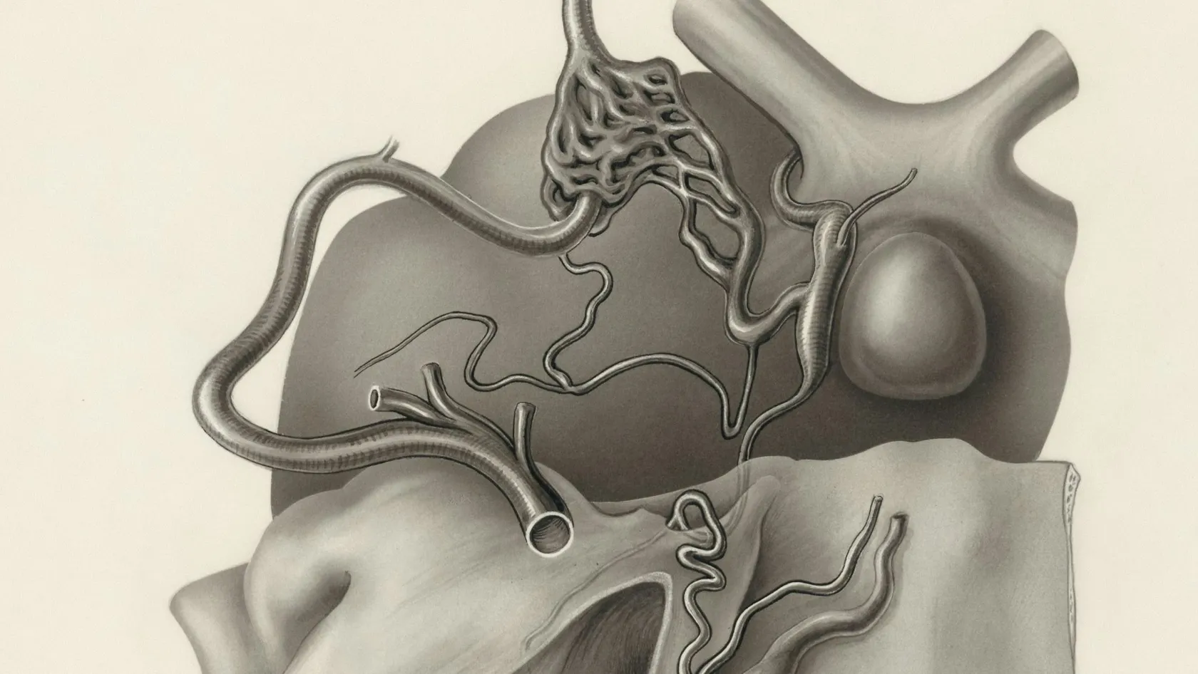 Reperméabilisation après vasectomie - vasovasostomie