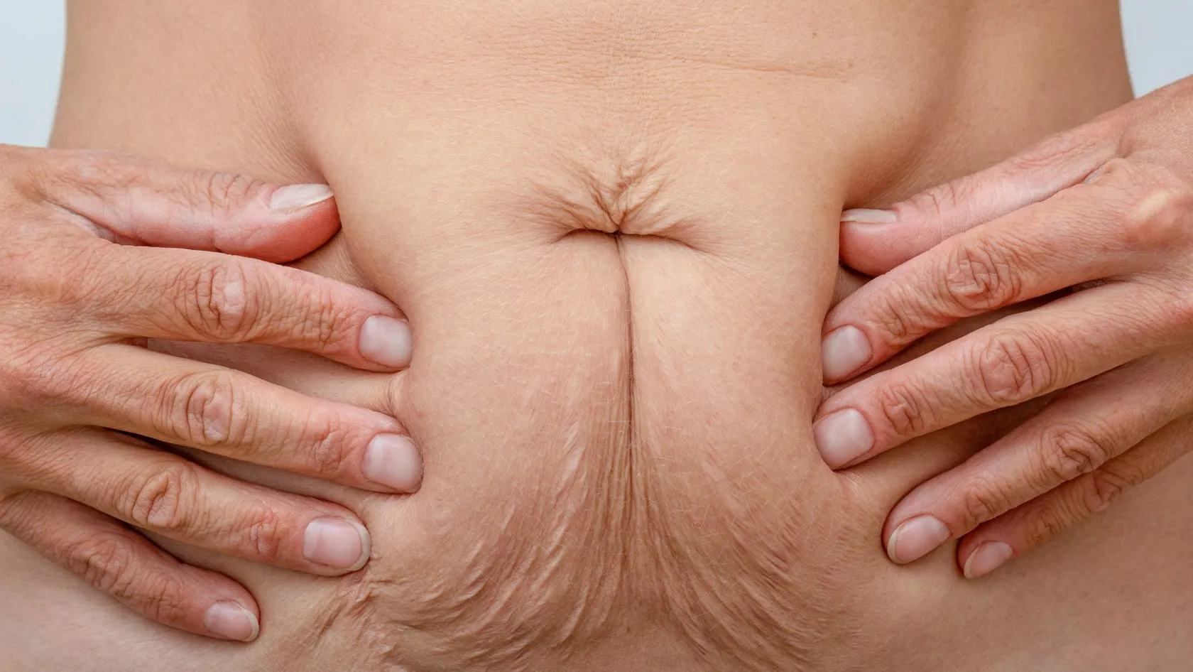 Chirurgie de la hernie