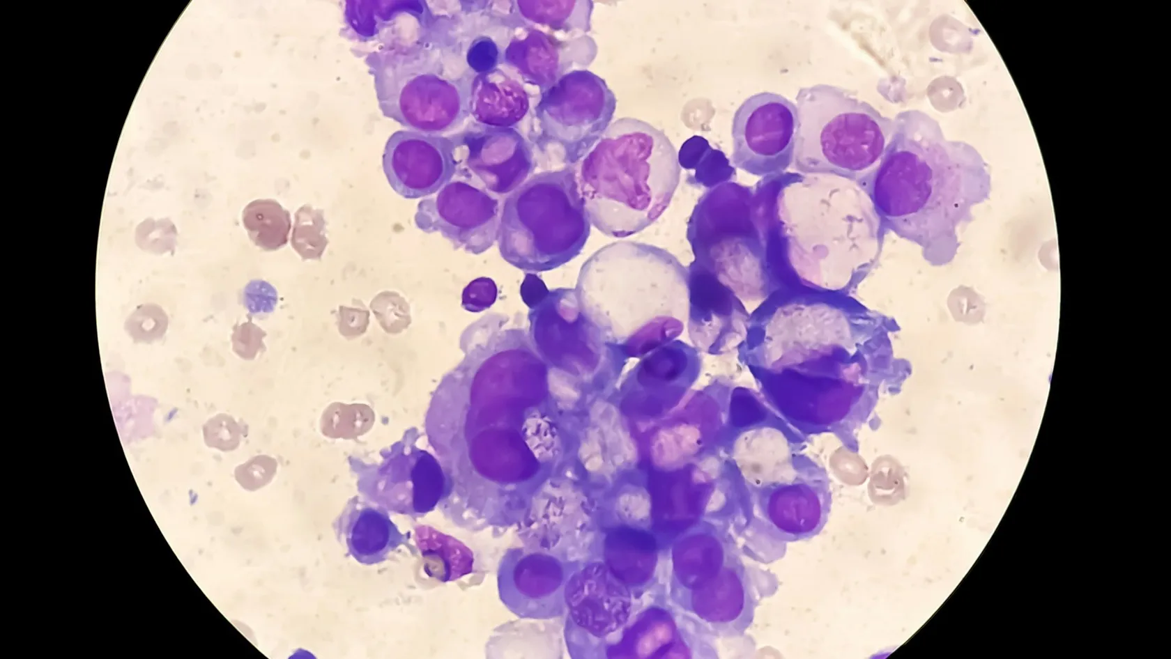 Greffe de moelle osseuse pour le lymphome de Hodgkin