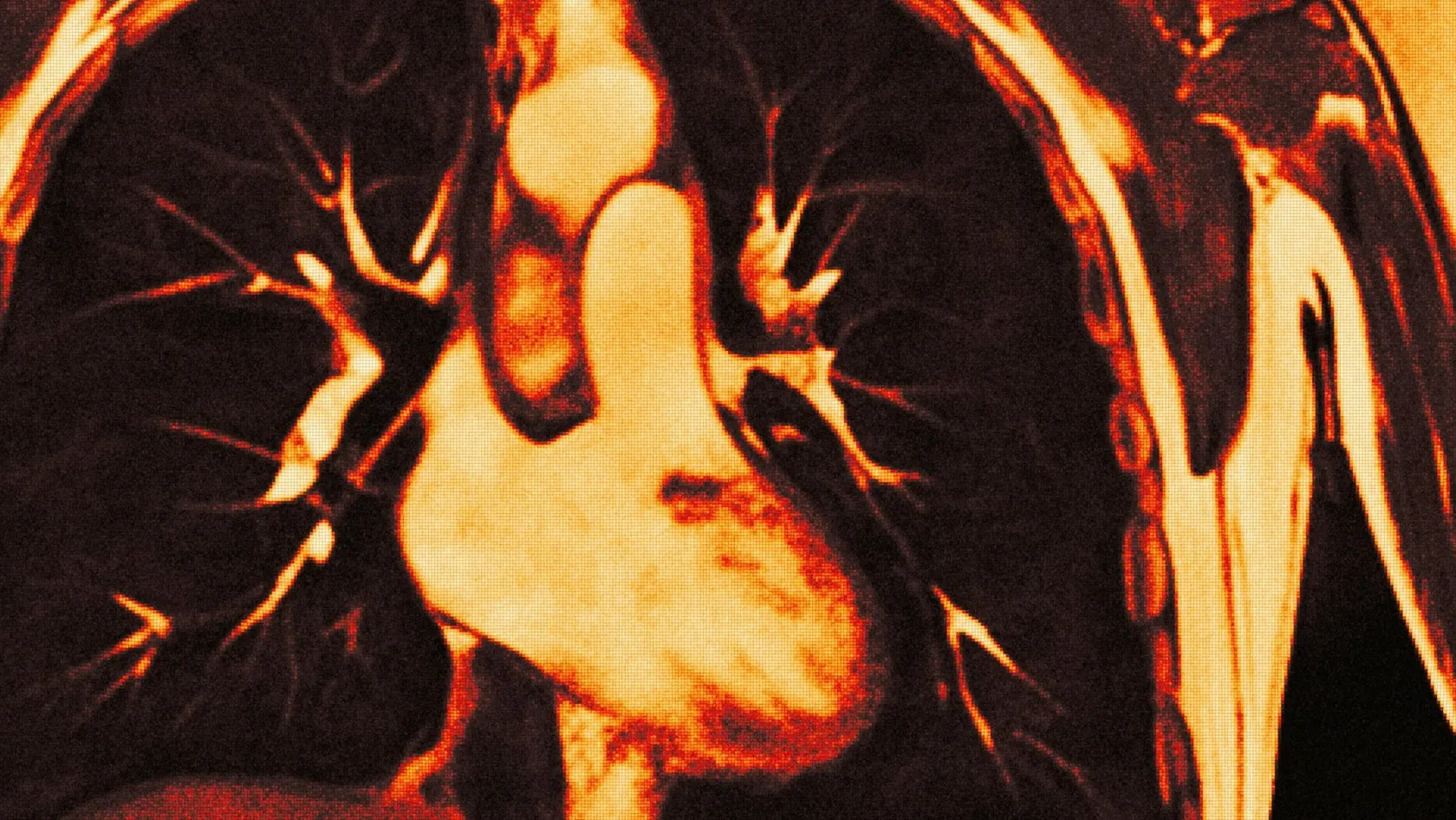 Lobectomie par VATS pour le cancer du poumon