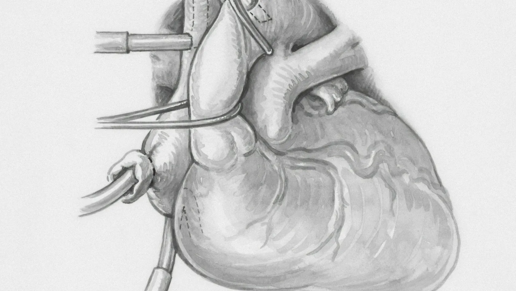 RFA - Ablation par radiofréquence