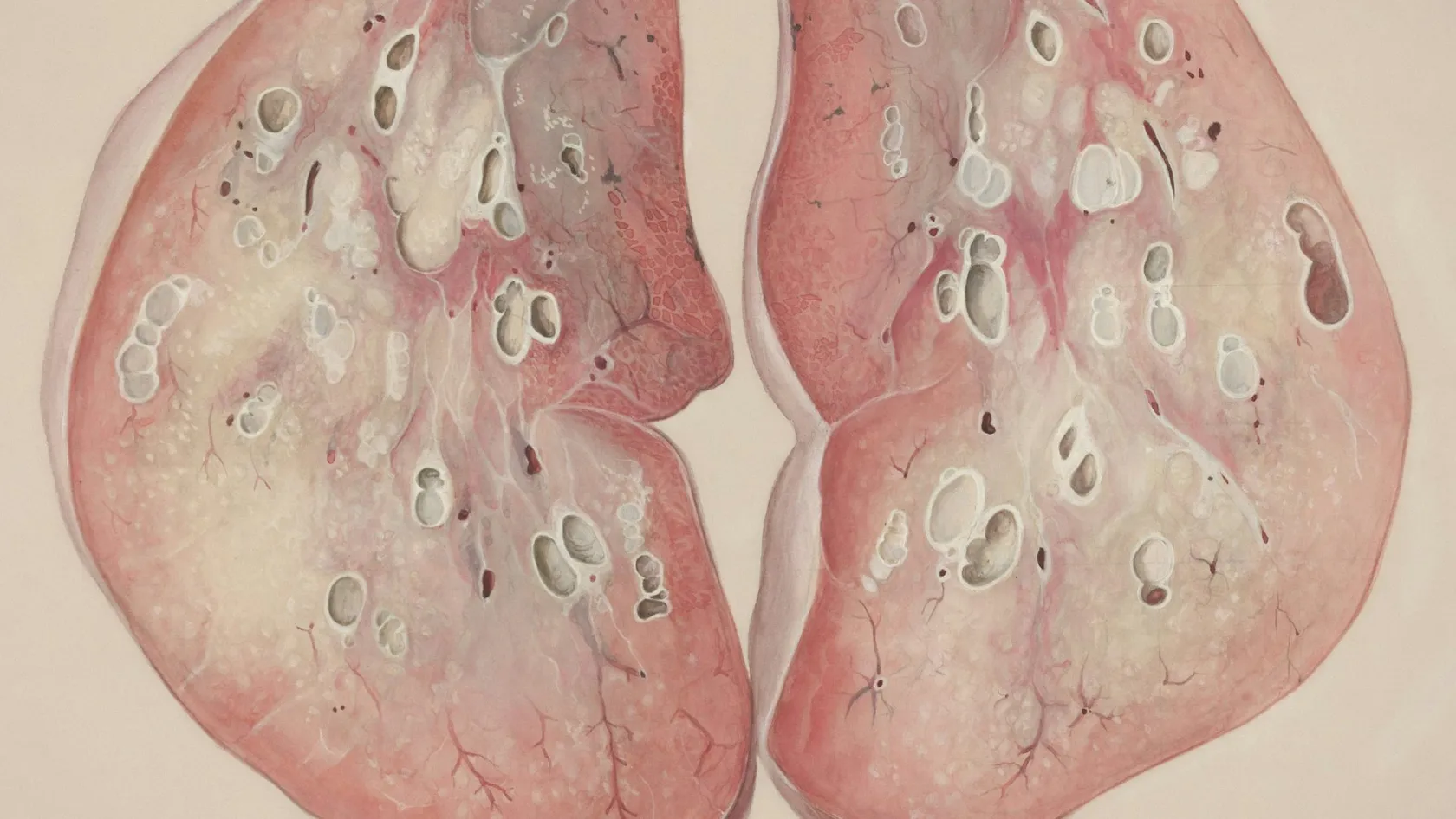 Traitement du CHC - Traitement du carcinome hépatocellulaire