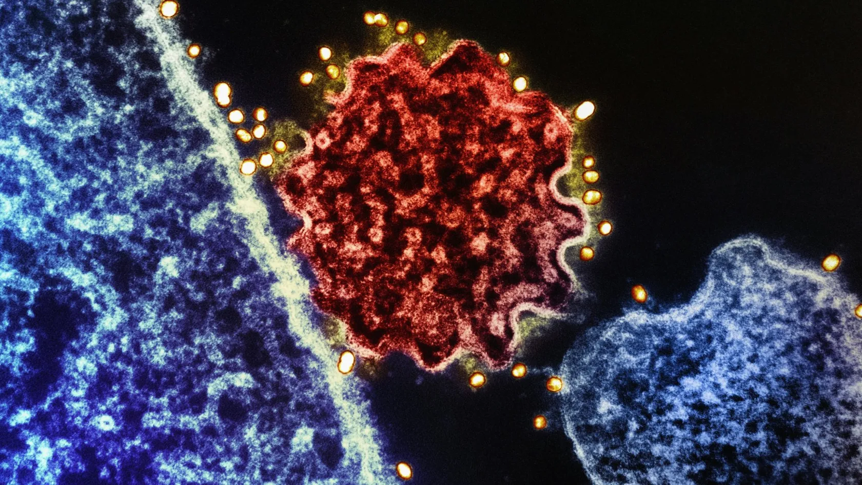 Traitement par nivolumab - Opdivo