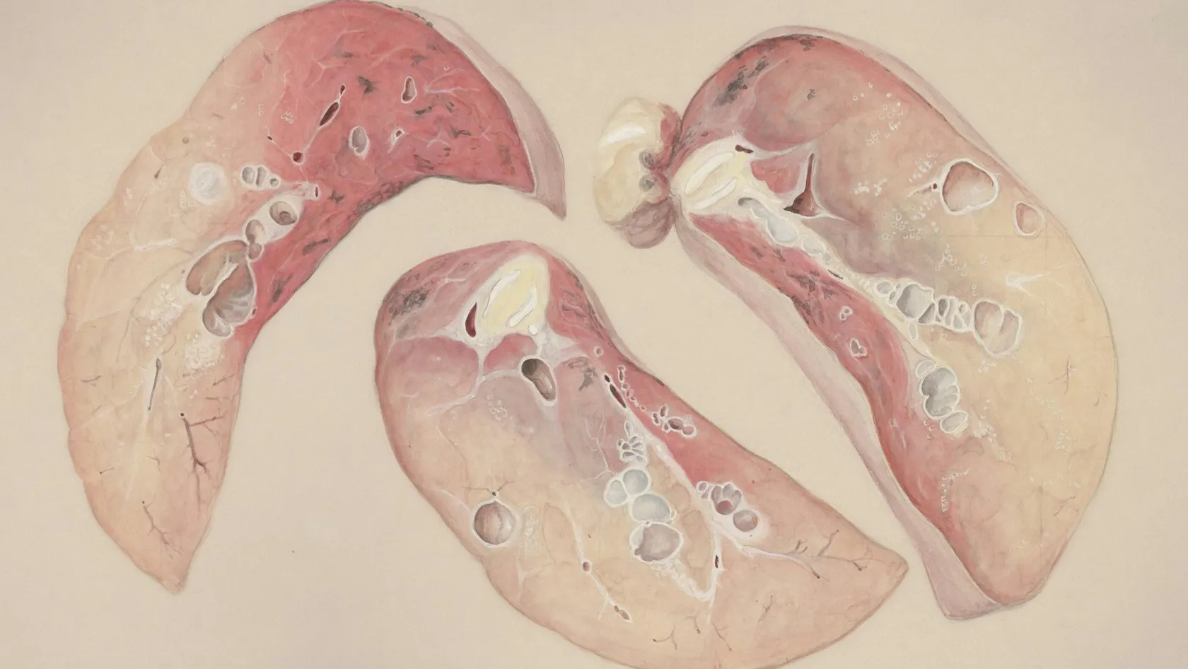 CHC - Transplantation hépatique pour carcinome hépatocellulaire