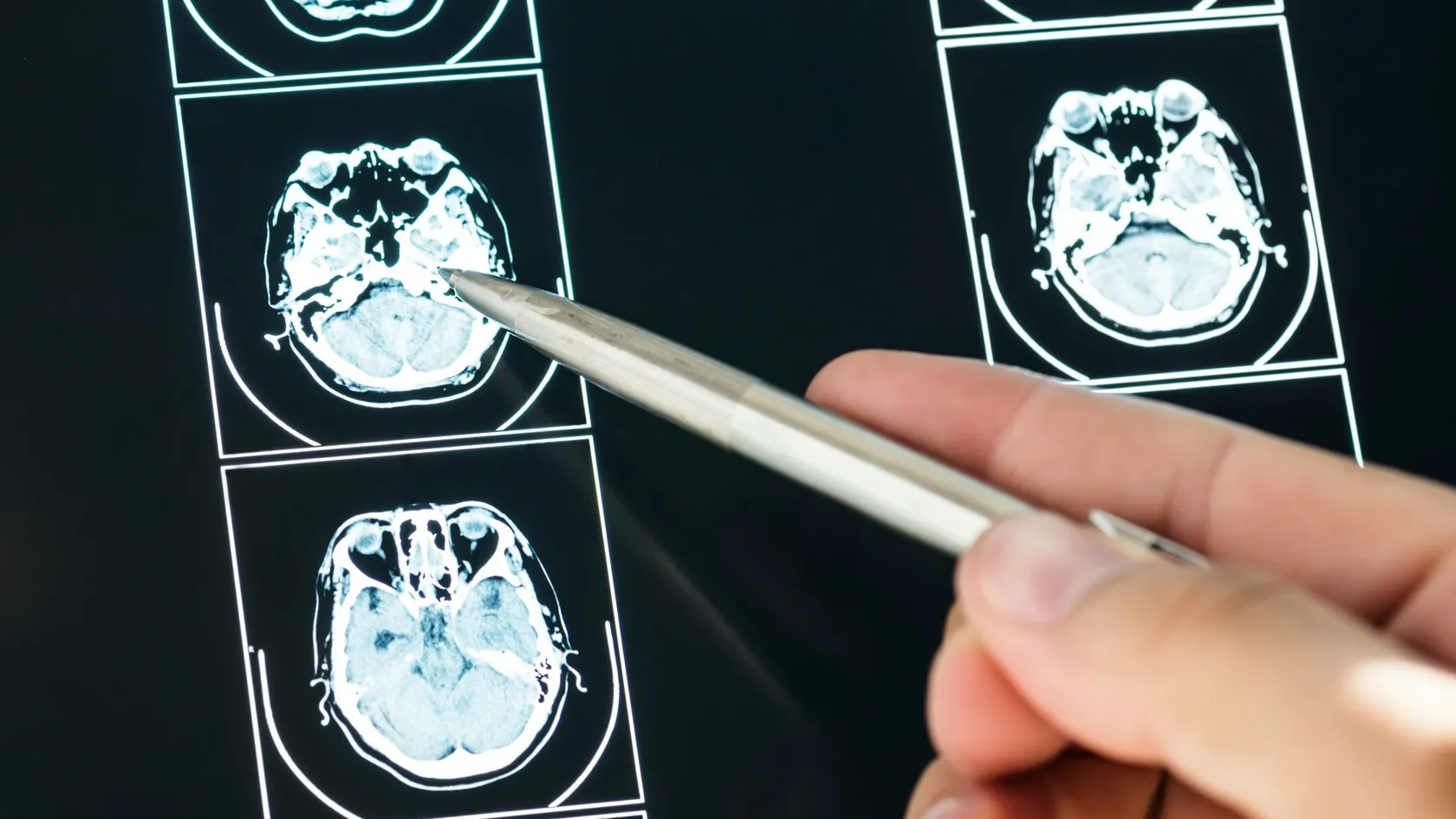 Scanner TEP/TDM au Dotatate - imagerie des tumeurs neuroendocrines