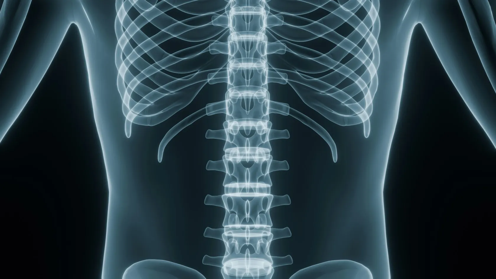 Chirurgie de la scoliose chez l’enfant