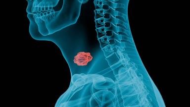 Chirurgie des cancers de la tête et du cou