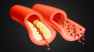 Angioplastie coronaire
