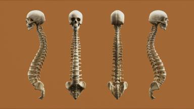 Chirurgie de fusion vertébrale - Arthrodèse vertébrale