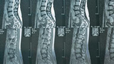 Ablation de hernie discale - Chirurgie de la hernie discale