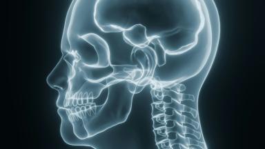 Chirurgie de la malformation de Chiari