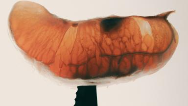 Dissection sous-muqueuse endoscopique - ESD